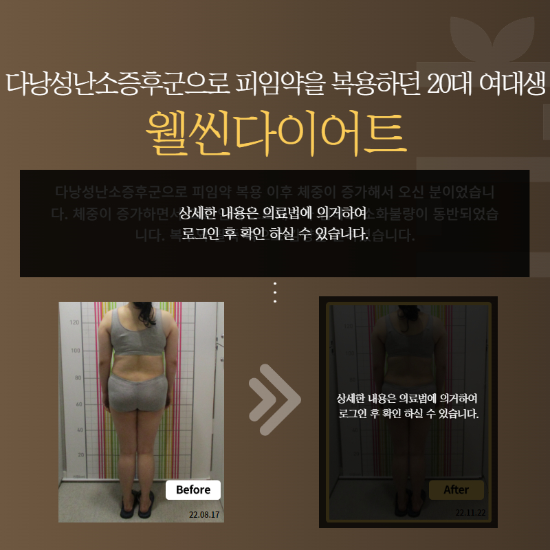 다낭성 난소 증후군으로 피임약을 복용하던 20대 여대생 웰씬다이어트