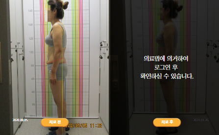 바로선치료 [50대 여성] 안면비대칭