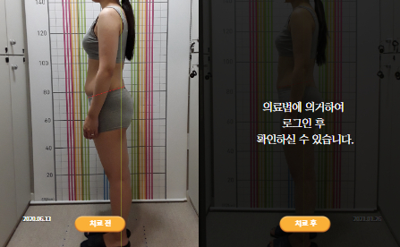 바로선치료 [20대 여성] 안면비대칭