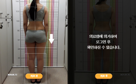 바로선치료 [20대 여성] 턱관절