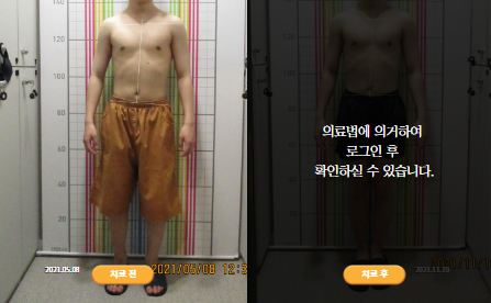 바로선치료 [20대 남성] 턱관절