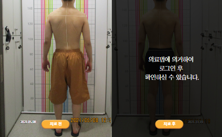 바로선치료 [20대 남성] 안면비대칭