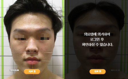 바로선치료 [20대 남성] 턱관절