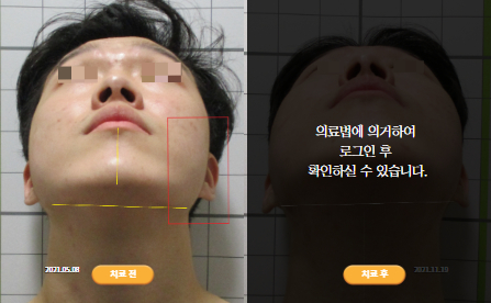바로선치료 [20대 남성] 턱관절