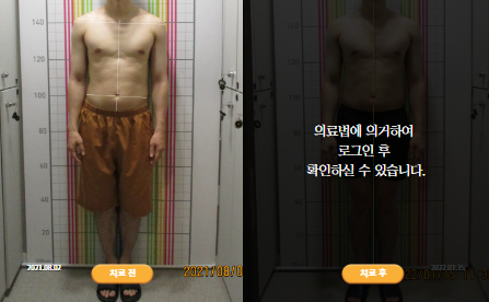 바로선치료 [30대 남성] 턱관절