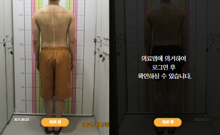 바로선치료 [30대 남성] 안면비대칭
