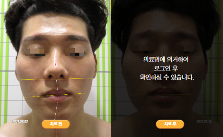 바로선치료 [20대 남성] 턱관절