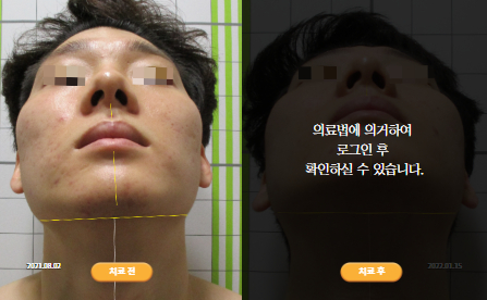 바로선치료 [30대 남성] 안면비대칭