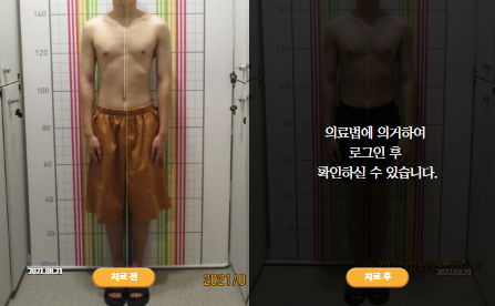 바로선치료 [10대 남성] 턱관절