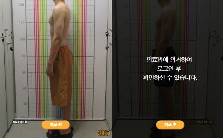 바로선치료 [10대 남성] 안면비대칭