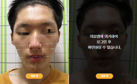 바로선치료 [10대 남성] 안면비대칭