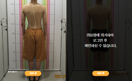바로선치료 [10대 남성] 안면비대칭