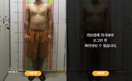 바로선치료 [30대 남성] 안면비대칭
