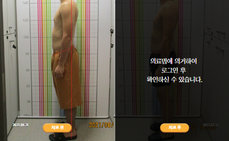 바로선치료 [30대 남성] 턱관절