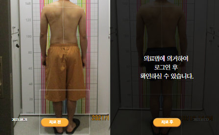 바로선치료 [30대 남성] 안면비대칭