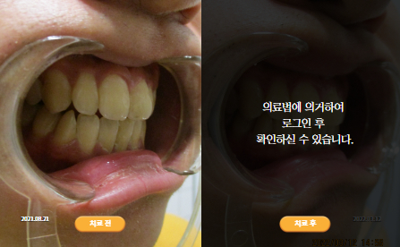 바로선치료 [30대 남성] 턱관절