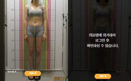 바로선치료 [20대 여성] 턱관절