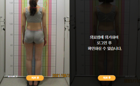 바로선치료 [20대 여성] 턱관절