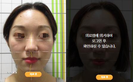 바로선치료 [20대 여성] 안면비대칭