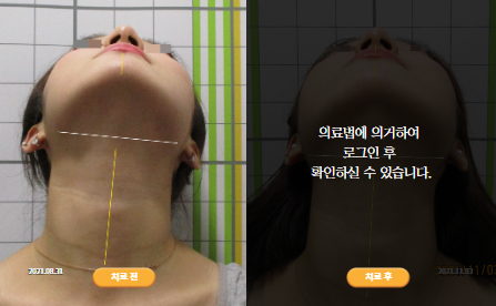 바로선치료 [20대 여성] 턱관절