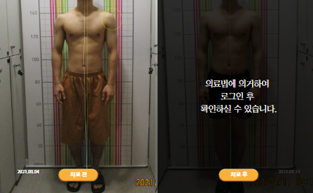바로선치료 [20대 남성] 턱관절