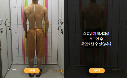 바로선치료 [20대 남성] 안면비대칭