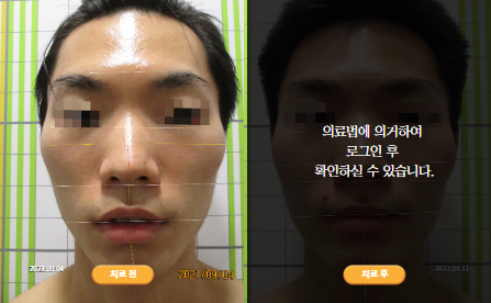 바로선치료 [20대 남성] 턱관절