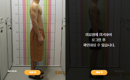 바로선치료 [20대 남성] 안면비대칭