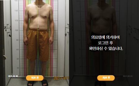 바로선치료 [50대 남성] 안면비대칭