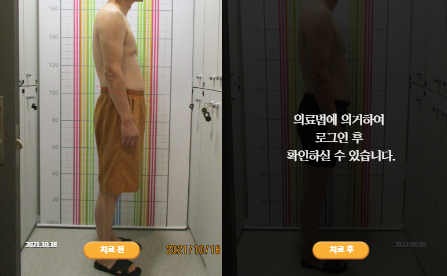 바로선치료 [50대 남성] 턱관절