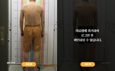 바로선치료 [50대 남성] 안면비대칭