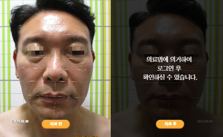 바로선치료 [50대 남성] 턱관절