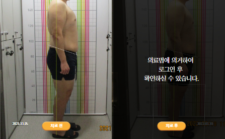 바로선치료 [20대 남성] 턱관절