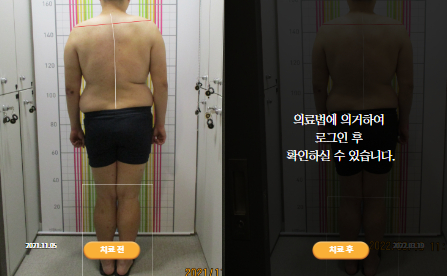 바로선치료 [20대 남성] 턱관절