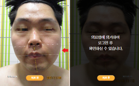 바로선치료 [20대 남성] 안면비대칭