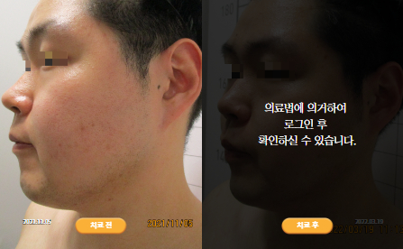 바로선치료 [20대 남성] 턱관절