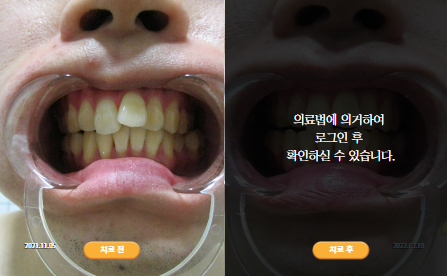 바로선치료 [20대 남성] 턱관절
