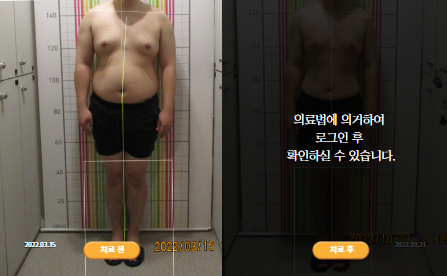 바로선치료 [20대 남성] 턱관절