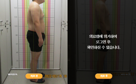 바로선치료 [20대 남성] 안면비대칭