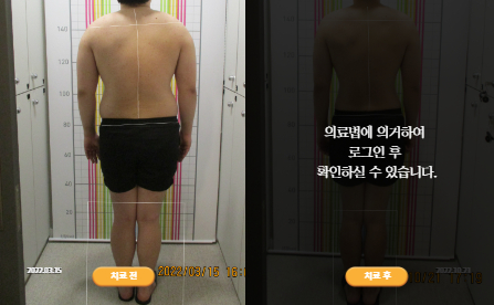 바로선치료 [20대 남성] 안면비대칭