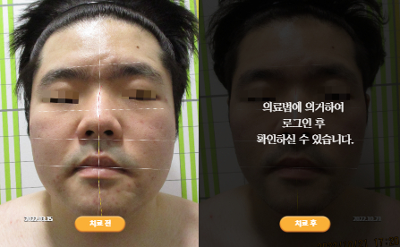 바로선치료 [20대 남성] 안면비대칭