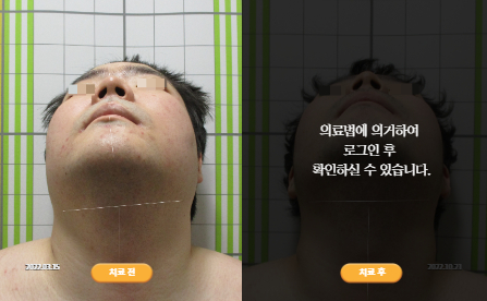 바로선치료 [20대 남성] 안면비대칭