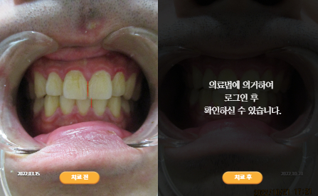 바로선치료 [20대 남성] 안면비대칭