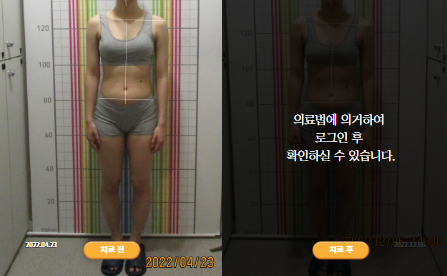 바로선치료 [20대 여성] 안면비대칭