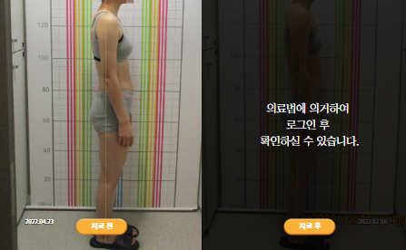 바로선치료 [20대 여성] 안면비대칭