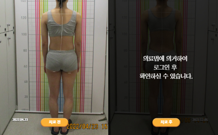 바로선치료 [20대 여성] 턱관절