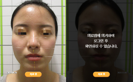 바로선치료 [20대 여성] 턱관절
