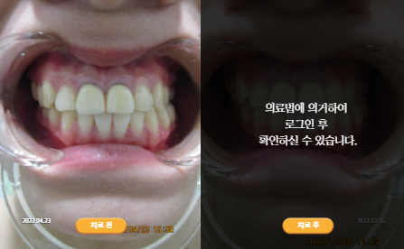 바로선치료 [20대 여성] 안면비대칭