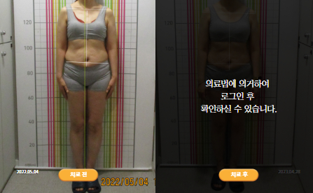 바로선치료 [50대 여성] 안면비대칭