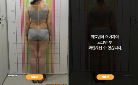 바로선치료 [50대 여성] 턱관절